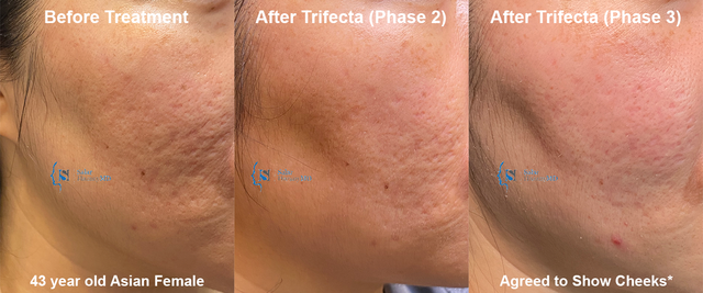 Acne scar treatment near outlet me